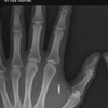 Implantaat in je hand 