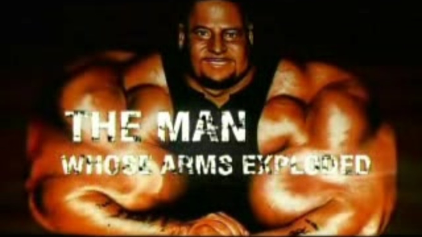 dumpert.nl - The Man Whose arms exploded